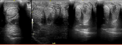 Low Frequency Ultrasound treatment compared to a control case