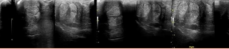 Low Frequency Ultrasound treatment compared to a control case